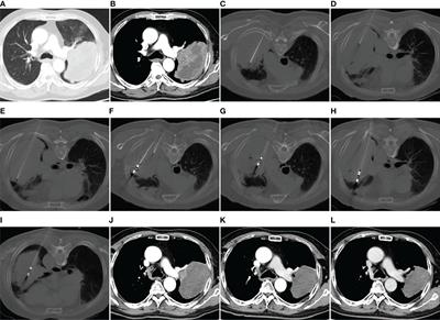 Synchronous Microwave Ablation Combined With Cisplatin Intratumoral Chemotherapy for Large Non-Small Cell Lung Cancer